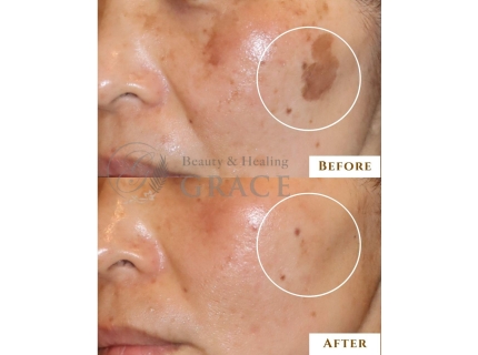 シミケア＆肌改善専門メディカルエステサロングレース