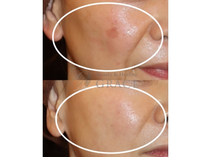 シミケア＆肌改善専門メディカルエステサロングレース