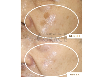 シミケア＆肌改善専門メディカルエステサロングレース